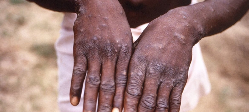 Two new cases of monkeypox are reported in the Dominican Republic