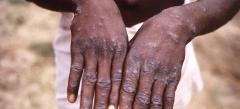 Two new cases of monkeypox are reported in the Dominican Republic: The Ministry of Public Health of the Dominican Republic reported this Wednesday about two new diagnosed cases of monkeypox in the country.